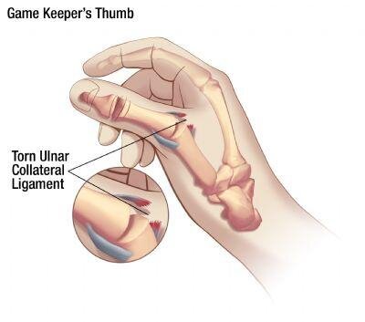 gamekeepers-thumb-injury-hyperabduction.jpg