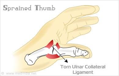 image-result-for-images-of-a-sprained-thumb.jpeg