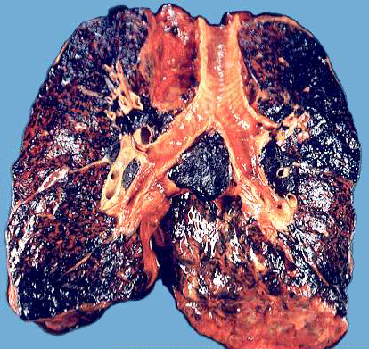 SMOKERS-LUNG.gif