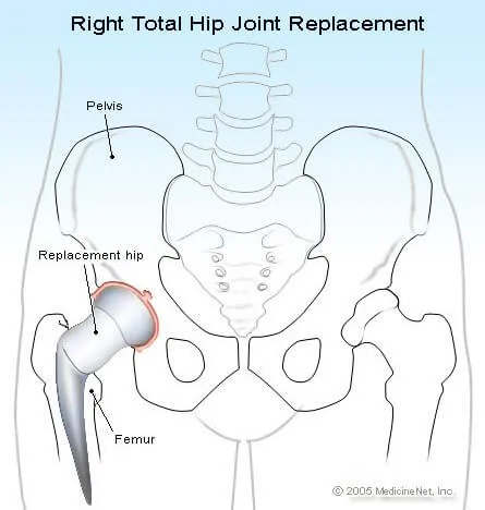 hip_joint_replacement.jpg